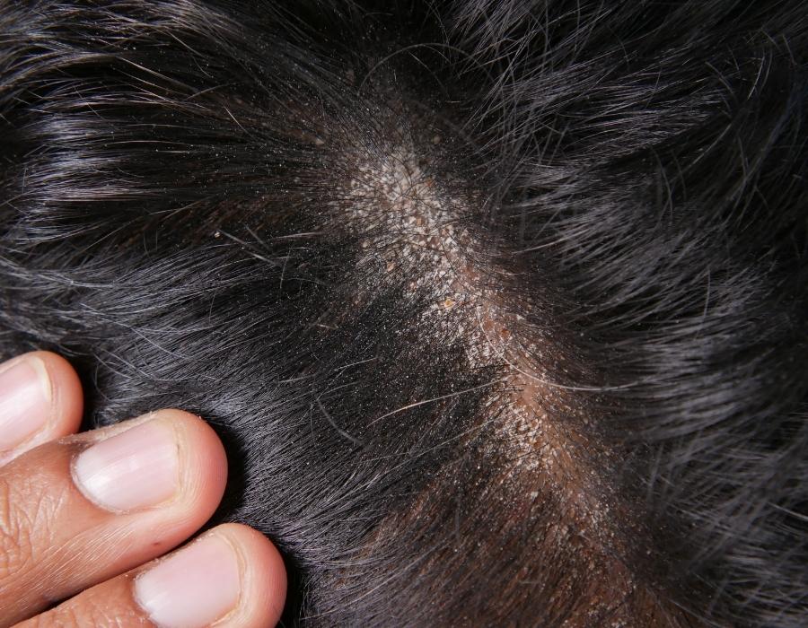 Bệnh nấm da đầu